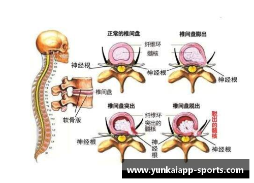 NBA球员腰椎间盘突出：症状、治疗及预防策略